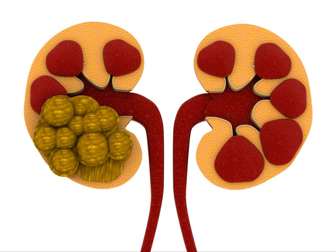 Best Kidney Stone Breaker In India