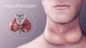 Signs and symptoms of hypothyroidism